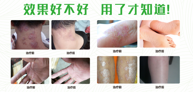 蜜桃视频在线入口WWW真菌清喷剂